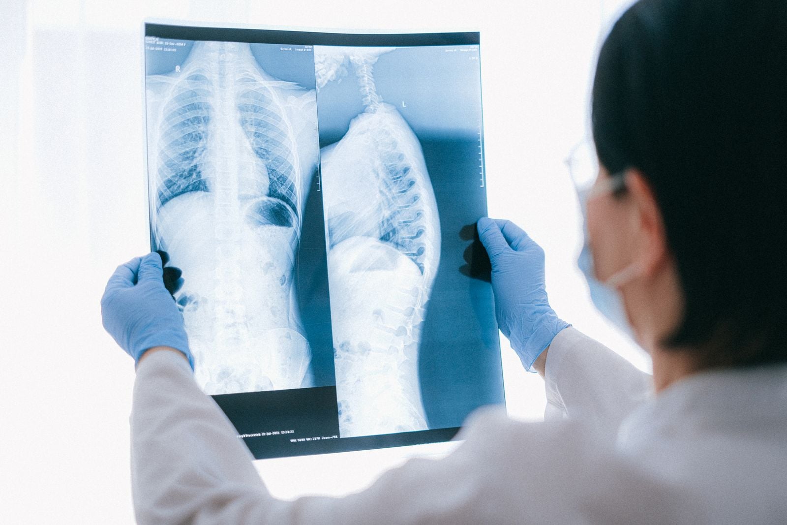 Photo illustrating scoliosis and spinal alignment