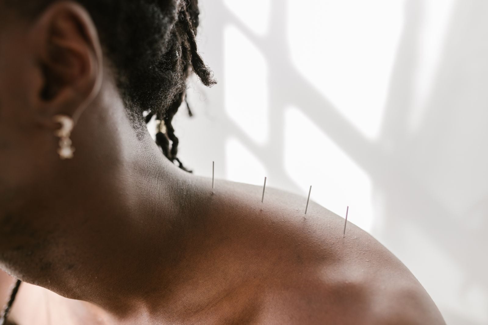 Fine acupuncture needles placed along a person's shoulder